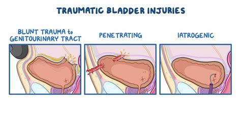 20k bladder tear test|bladder injury statistics.